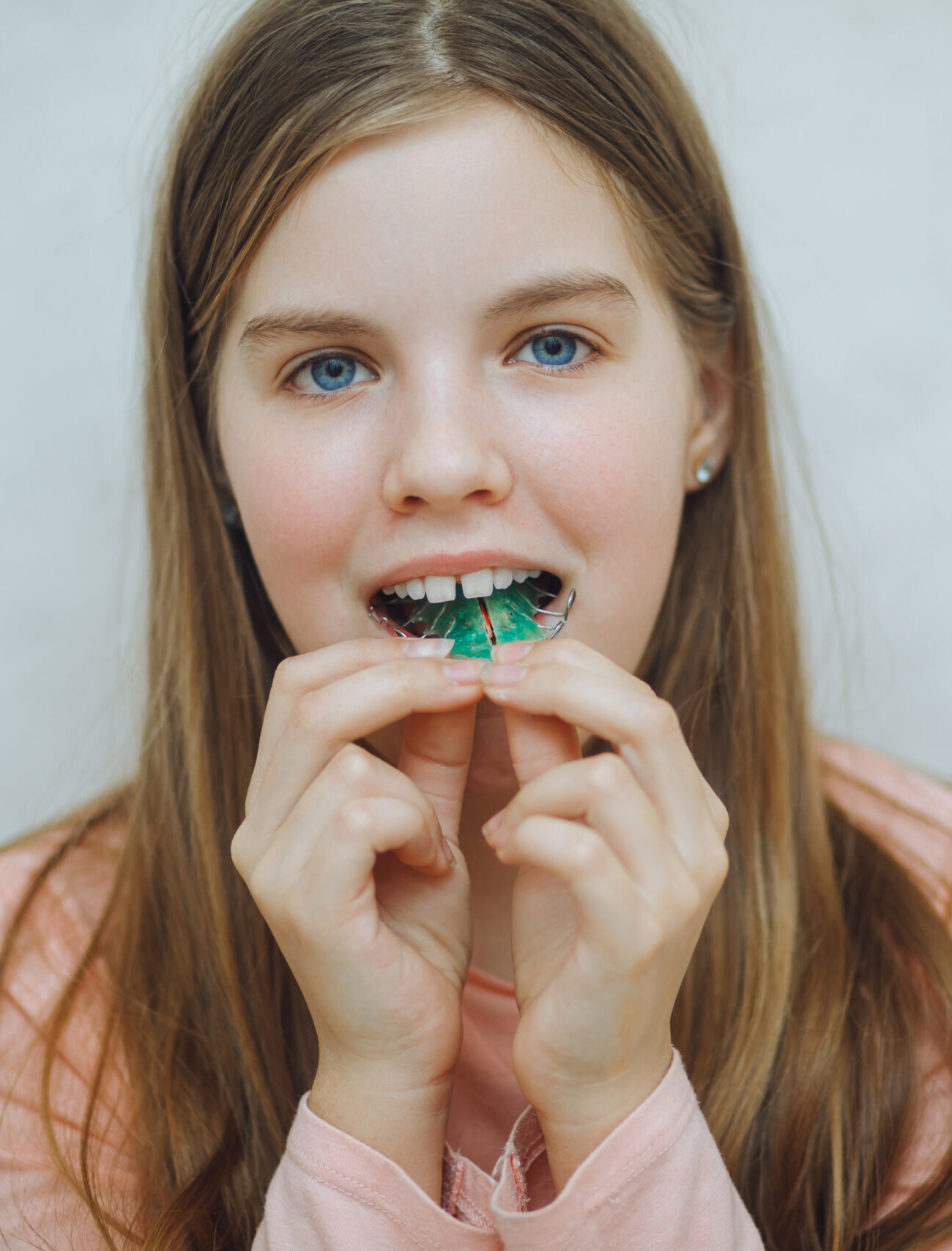 Dental plate. Expansion of the jaw in a child. There is not enough space for molars. Happy girl holding an orthodontic plate in her hands