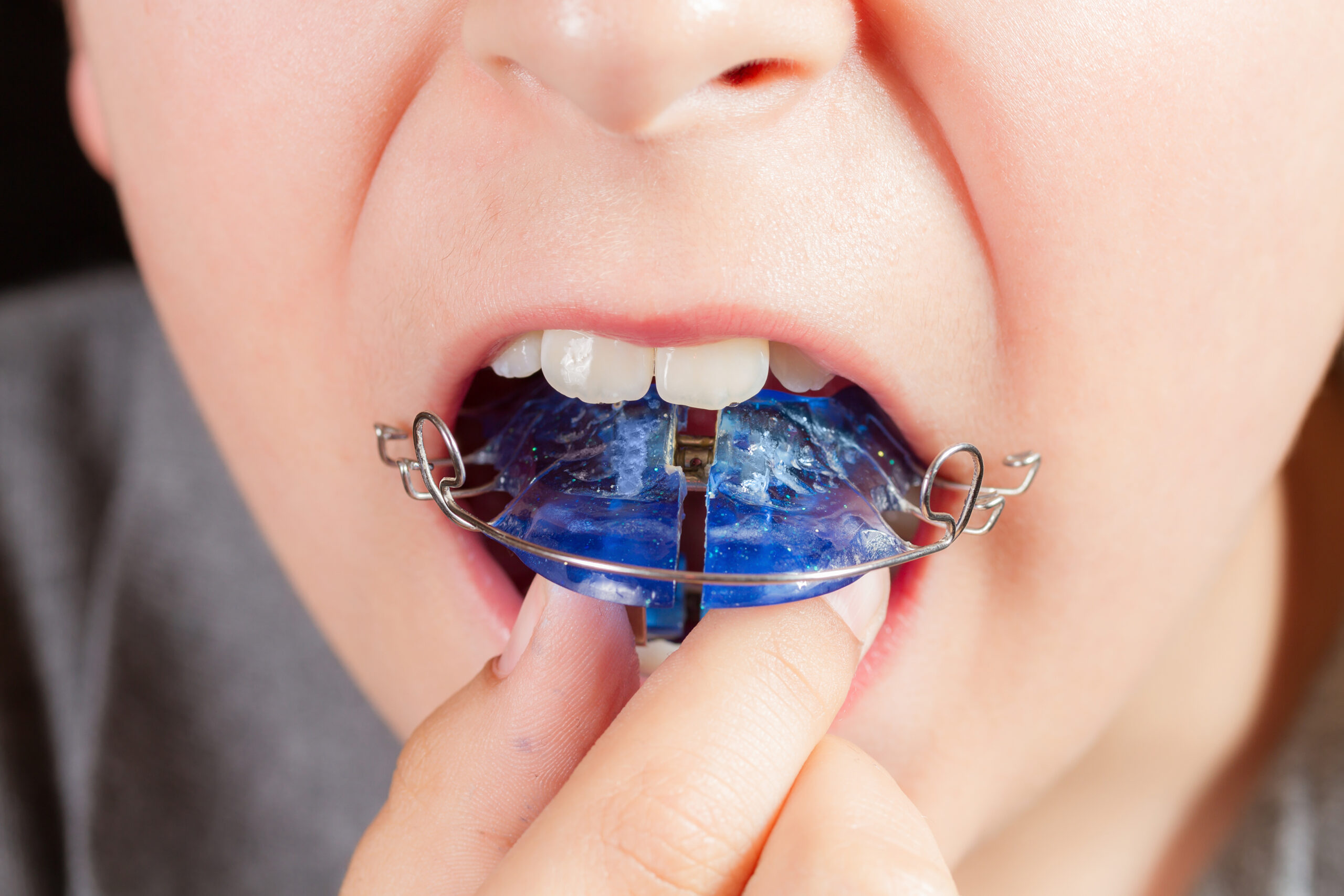 Child with orthodontic habit-breaking appliance at dentist appointment