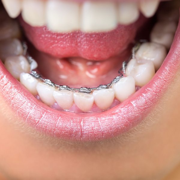 Lingual Braces
